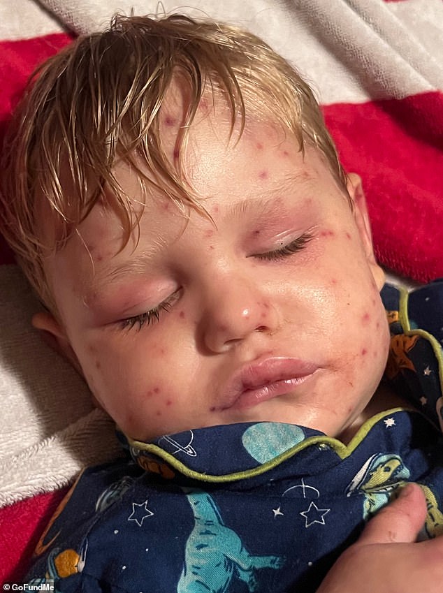 His parents Mariah and Peyton rushed the little one to the hospital, where he as given morphine and Benadryl and sent home. He later went into multiple organ failure