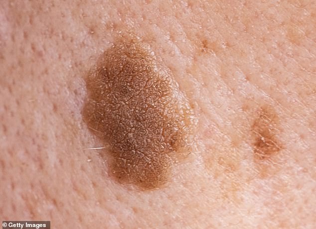 The ones you don’t need to worry about are seborrheic keratoses – benign growths affecting half of men and more than a third of women