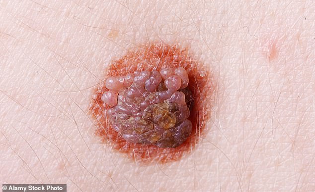 Most moles are absolutely nothing to worry about – from big knobbly ones and unslightly hairy ones to the small red ones
