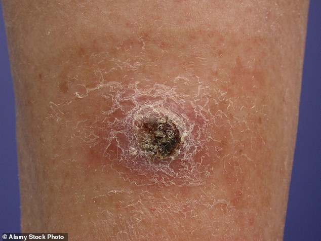 Squamous cell carcinomas – SCCs – may begin as red, scaly patches but can ulcerate, become lumpy, painful and weepy. They are increasingly common