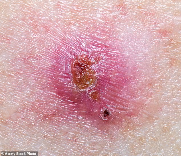 A persistent spot that doesn’t clear within several weeks, and may intermittently bleed or crust, should be checked as it could be a basal cell carcinoma – BCC