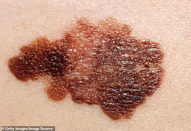 The main cause for concern is melanoma. These vary but a key rule is to watch for any mole that's change in size, shape, outline, if it has scabbed or started bleeding