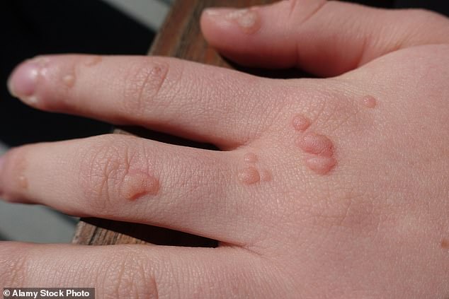 Warts are extremely common growths caused by the HPV virus. They can be itchy or embarrassing – but the good news is that they aren't harmful