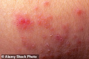 Common skin conditions such as eczema (pictured) and psoriasis can be painful and disfiguring but today there are treatments which can offer relief