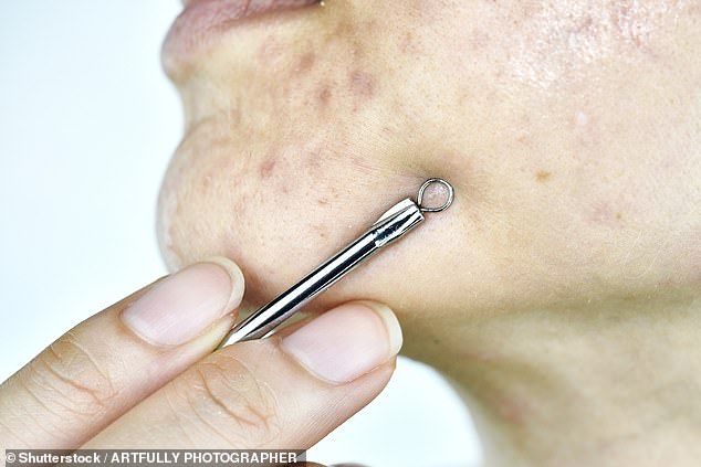 While the doctor warned never to squeeze your spots, some in particular he explained have a higher risk of scarring