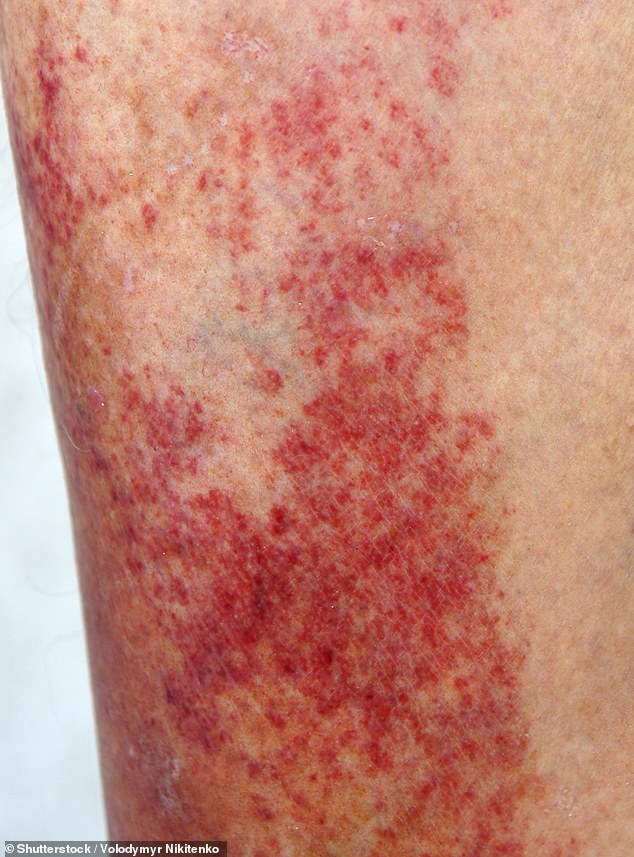 Allergic contact dermatitis on a person's shin after they made contact with poison hemlock