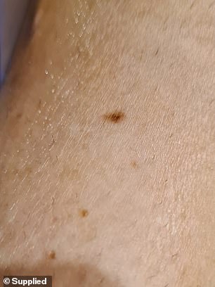 More melanomas (left and right) appeared in the years that followed