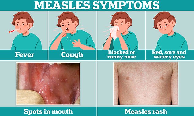 Cold-like symptoms, such as a fever, cough and a runny or blocked nose, are usually the first signal of measles. A few days later, some people develop small white spots on the inside of their cheeks and the back of their lips