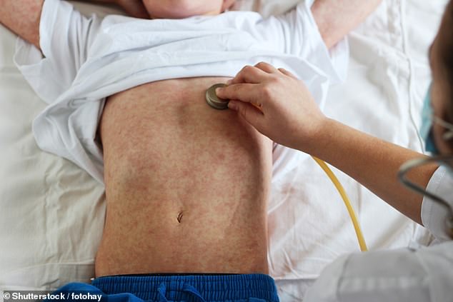 Experts labelled the figures as concerning and urged parents to vaccinate their children to avoid the 'life-long consequences' of a potential measles infection