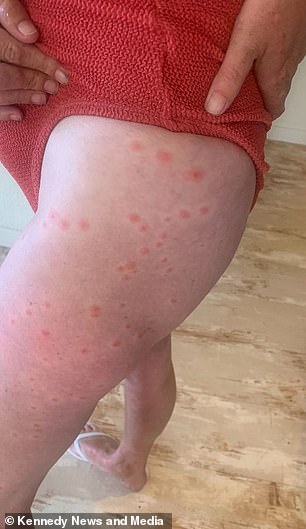 She went to hospital and was prescribed injections