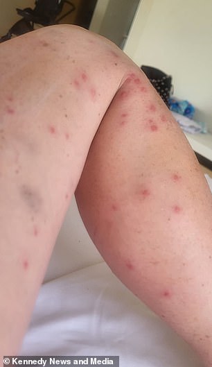 Just 10 days into the trip, the mother-of-two woke up with a 'really bad case' of mosquito bites