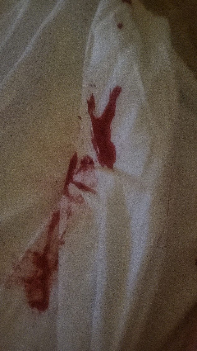 A hospital CT scan revealed she had a brain bleed and neck fractures so she was put in an induced coma. Pictured: Blood left on Ms Hickey's bedsheets from her mosquito bites