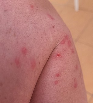 Ms Hickey's mosquito bites