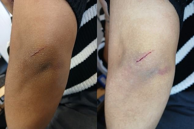 The image on the left shows a photo taken without the device where bruising is barely visible. The image on the right taken using Project Archway shows the injury more clearly