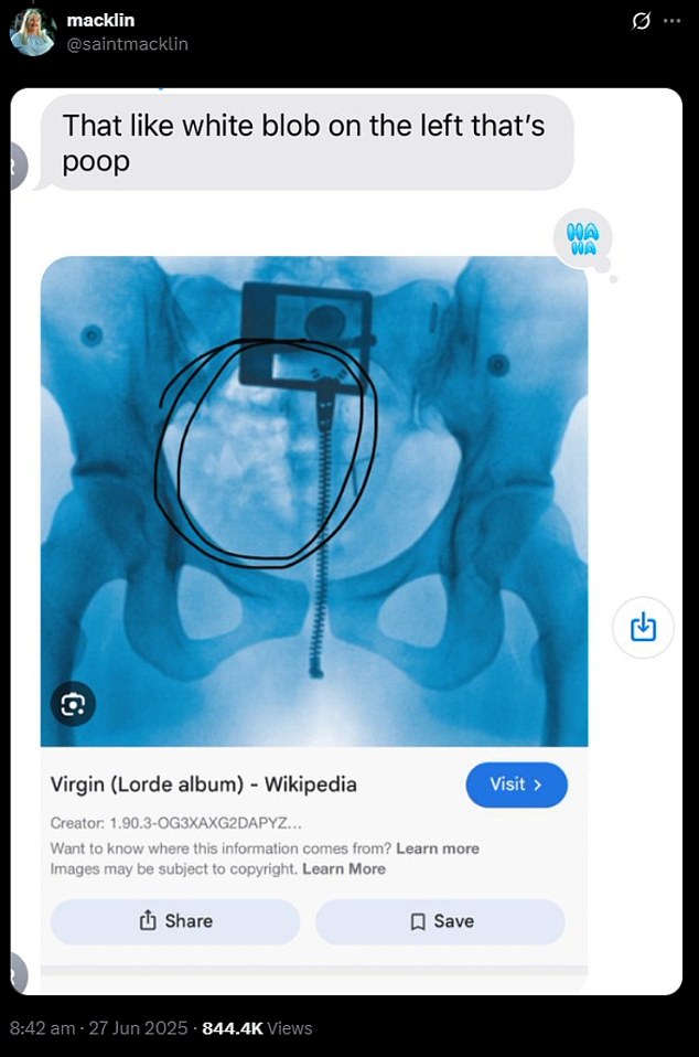While it is unclear if Aran is actually a 'certified radiologist', he is not the only fan who has made the claim Lorde's X-ray shows faeces in the bowels