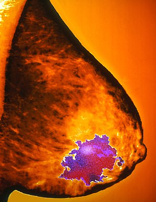 On a mammogram dense tissue shows as white, as do tumours – making them harder to detect
