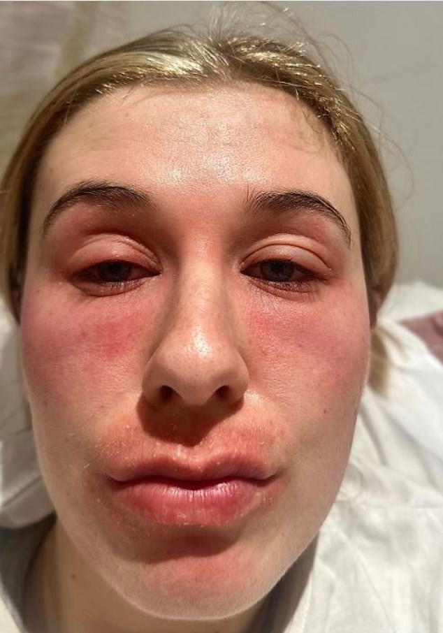 Katie Mackie says that during an eczma flare-up her eyes can swell so much she cannot open them