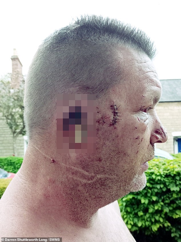 Darren Shuttleworth-Long, 52, from Swindon was sleeping peacefully next to an XL Bully on his sofa on April, 26, but was woken up after it started biting him, ripping his ear off