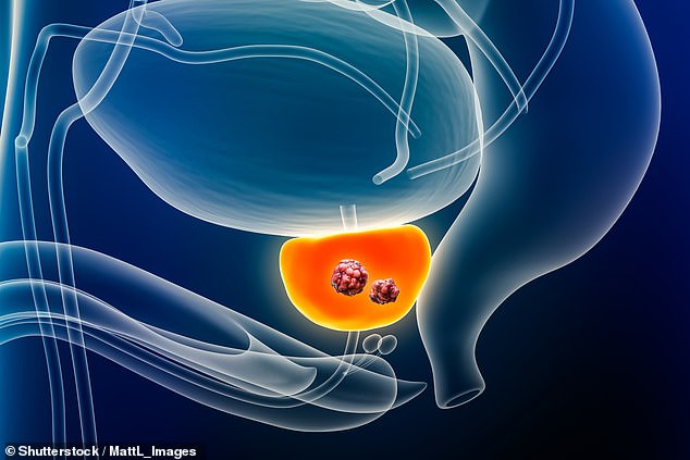 Causes of prostate cancer are largely unknown but the chances of developing the disease increase with age. Most cases develop in men aged 50 or over