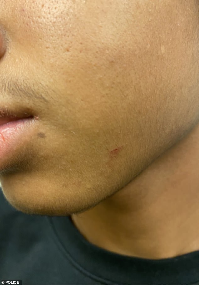 A scratch on his jaw allegedly suffered during the struggle