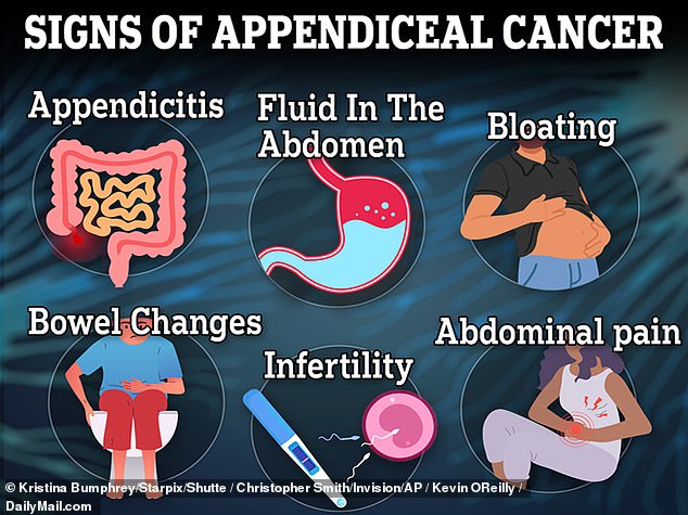 The above graphic shows the symptoms of appendiceal, or appendix, cancer. Doctors are detecting a mysterious rise in cases of the disease