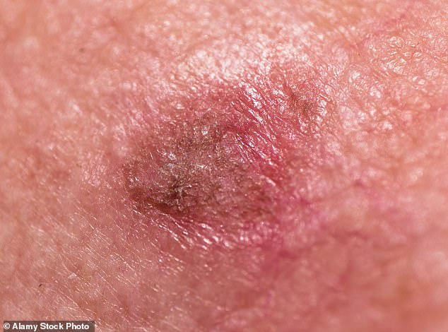More worrisome are actinic keratoses – also called solar keratoses – dry, scaly patches that feel rough, like sandpaper.