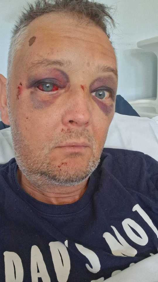 Close-up of a man with a fractured skull and brain damage after an attack.