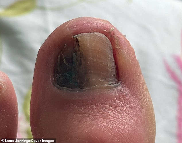 A mother-of-one is urging people not to ignore mysterious marks on nails after what she thought was a simple bruise turned out to be a deadly form of cancer . Laura Jennings, 40, from Leeds, first noticed a dark streak beneath her toenail in April 2022, but thought nothing of it. It turned out to be a deadly form of skin cancer