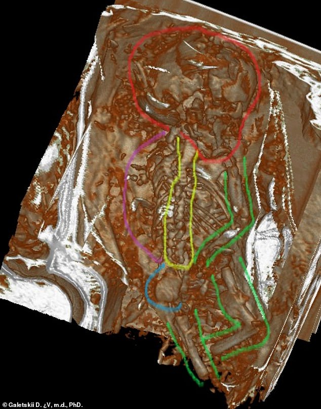 When scientists reconstructed the fetus, they saw that the face had turned backward. At the time of death, the bones were still soft and not fully developed