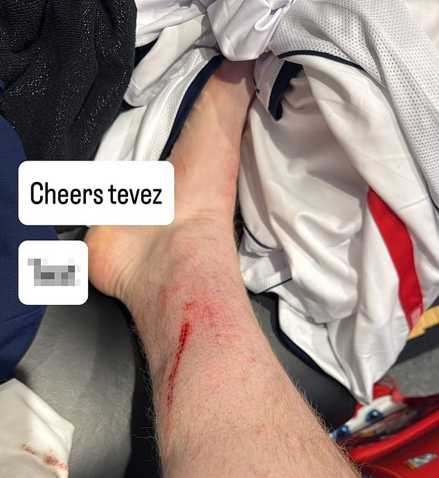 Angry Ginge took to social media to share a photo of a cut on his leg left by Carlos Tevez