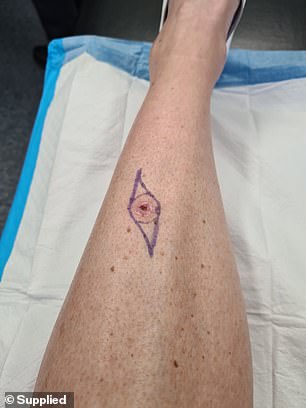 Melissa underwent a wide local excision on the melanoma on her back only to find the margins weren't clear (a later melanoma found on her leg pictured)
