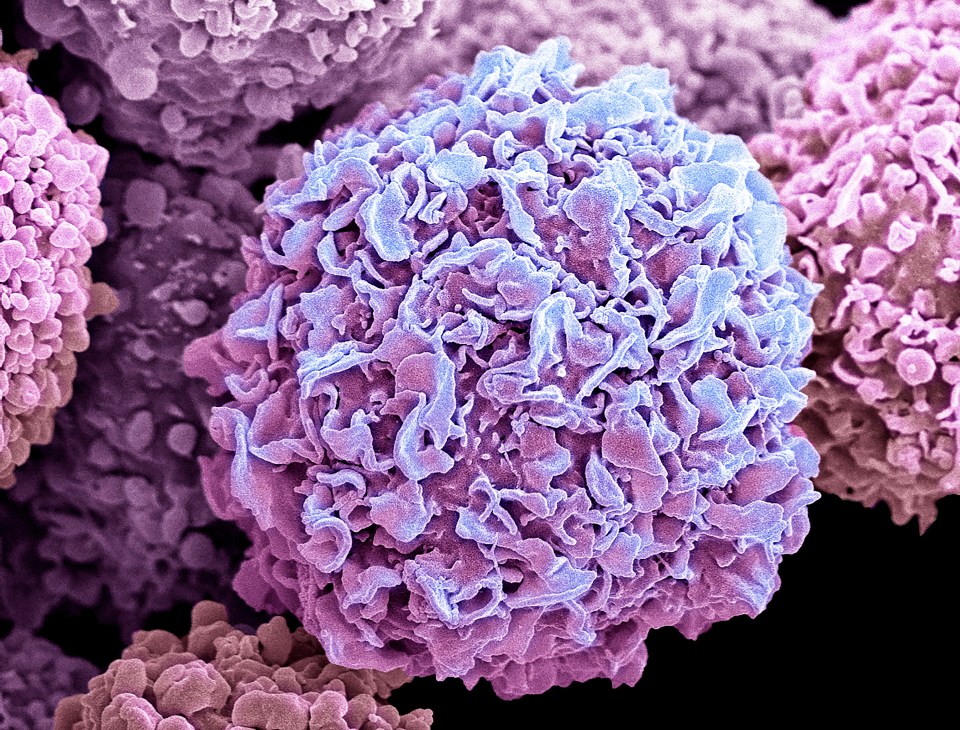 Breast cancer cells. Coloured scanning electron micrograph (SEM) of breast cancer cells. The cells shows numerous processes and microplicae (fine surface folds). These features are characteristic of highly mobile cells, and enable cancerous cells to spread (metastasis) rapidly round the body, and invade other organs and tissues. Cancer cells divide rapidly and chaotically, and may clump to form malignant tumours. The tumours often invade and destroy surrounding tissues. Breast cancer is the most common form of cancer in women. Treatment involves surgical removal of the tumour, often combined with radiotherapy and chemotherapy. Magnification: x3500 when printed 10cm wide.