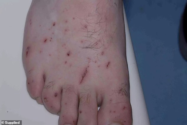 He sustained injuries to his hands and feet after testing out explosives in his home