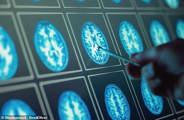 Changes in sight, hearing, taste, touch and balance are little-known dementia signs that can strike years before more well-known symptoms, experts have warned