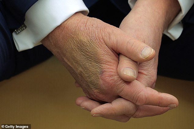 Makeup covers a bruise on the back of U.S. President Donald Trump's hand as he hosts French President Emmanuel Macron for meetings at the White House on February 24, 2025 in Washington, DC. Trump has been spotted with apparent makeup on the hand repeatedly before and since he took office