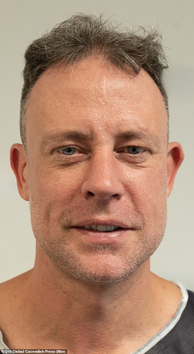 Wayne Bridge has revealed the results of his £7,000 hair transplant as he shared his delight with how the procedure had gone (pictured before)