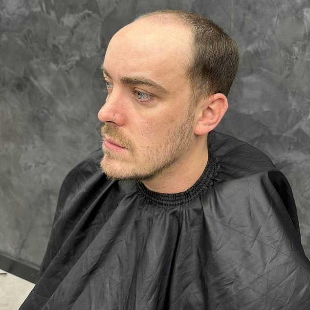 Sales executive Josh Kent began losing his hair in his late teens, and he initially thought that the best solution would be a hair transplant