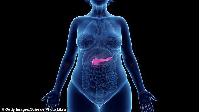 Acute pancreatitis is a painful condition which occurs over a short period of time when the pancreas (in red) becomes inflamed