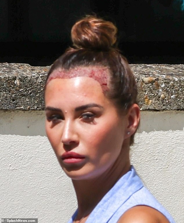 With her brunette locks pinned up in a bun on top of her head, the initial red results of the hair transplant could be seen across her hairline