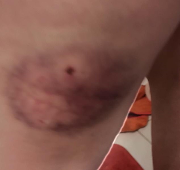 Bongolan said the bruise happened when Diddy grabbed her and dangled her over the balcony