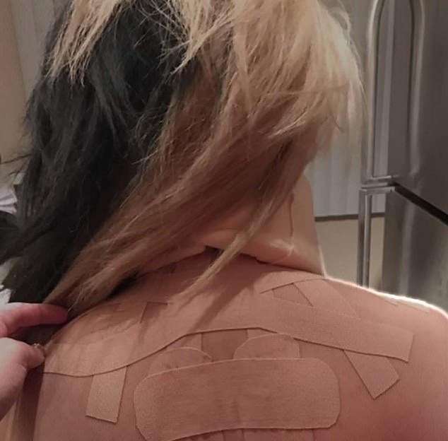 Bongolan is seen with bandages on her back in an image shown to the jury
