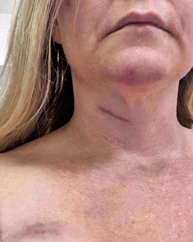 Pictures taken of Ms Giuffre at Royal Perth Hospital appear to show her with a black eye and other bruises to her face, neck and chest