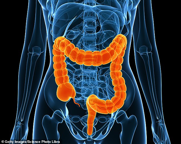 Scientists have now developed a tablet that could eliminate distressing symptoms for patients with severe bowel diseases like ulcerative colitis