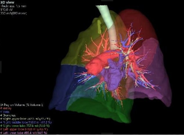 This 3D reconstruction of Cheng's CT scan shows a considerable chunk missing from one of his lungs