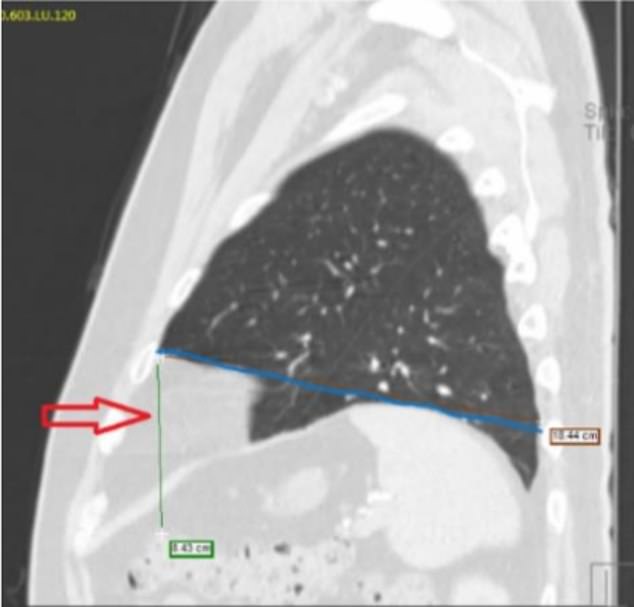 About half of Cheng's lower left lung lobe is missing