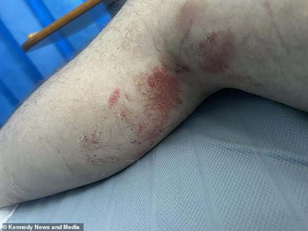Karl admits that some areas of his manhood are unrecognisable and he is still unsure if they 'work or function' but he remains hopeful it is OK. Pictured: Injuries to Karl's leg following the incident