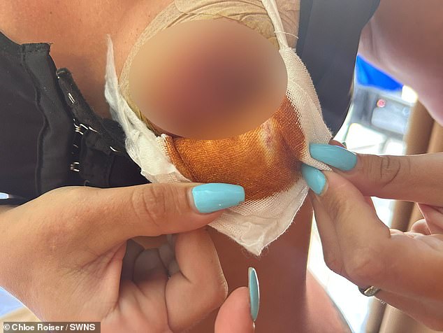 When she removed the tape she discovered that her nipples were infected