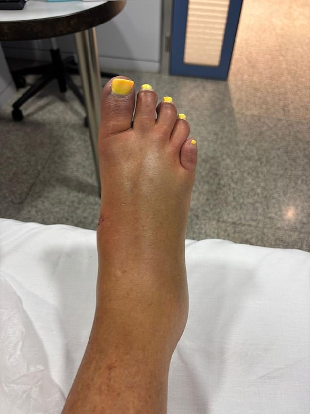 Mrs Elkinson, 57, also suffered a bad break to her right foot and underwent a three-hour operation on Saturday, when surgeons inserted pins and plates to repair it