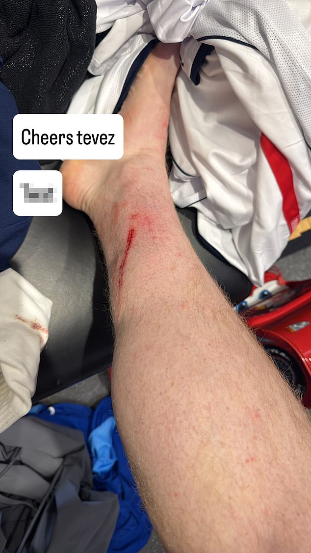 But Tevez left something in on him and AngryGinge was left with a nasty gash on his leg