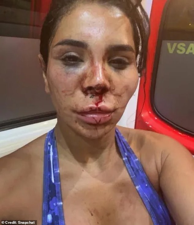 The influencer shared a video showing her bruised face on social media